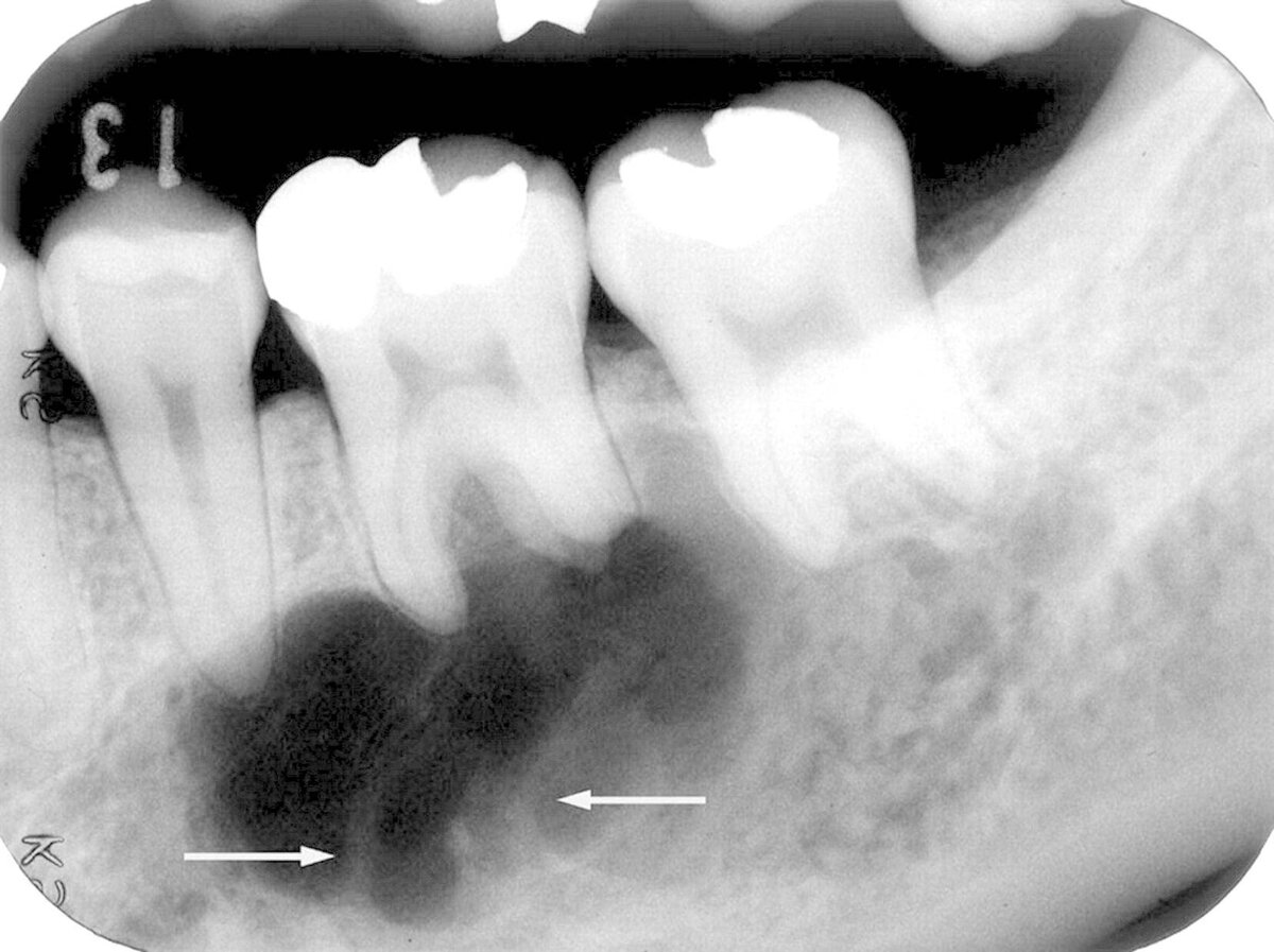 осколки после удаления зуба фото