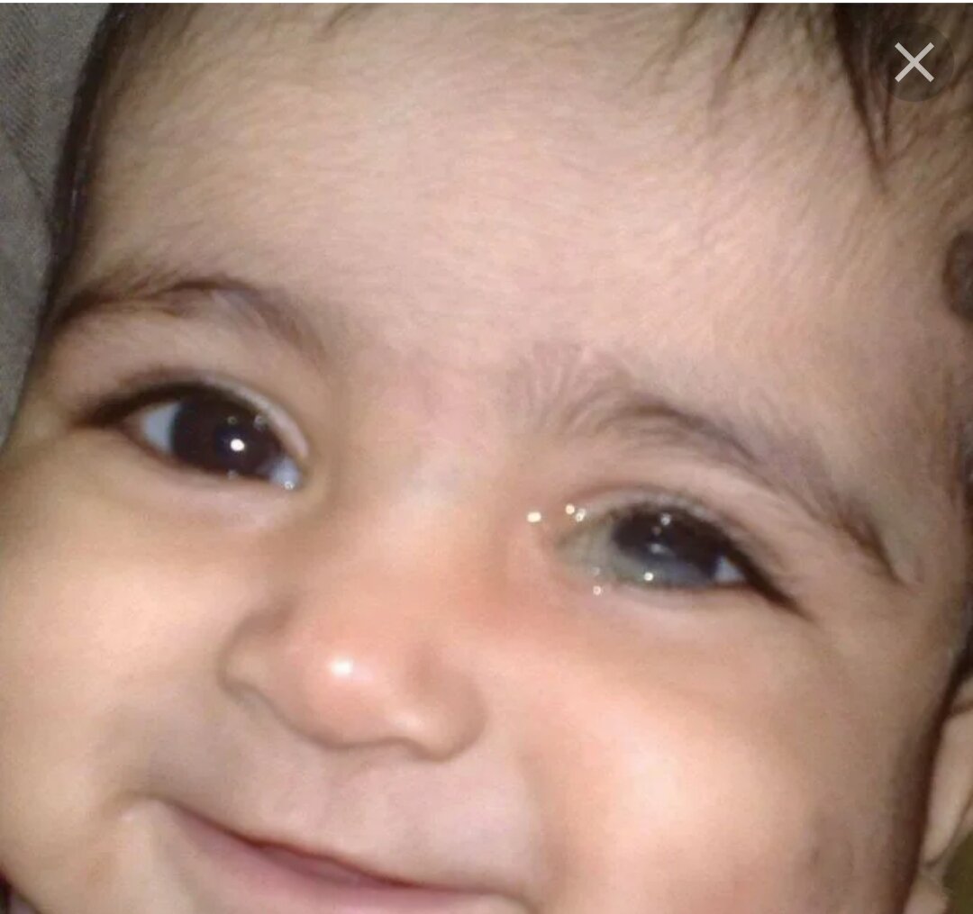 Из открытых источников. Видно стояние слезы и наличие слизисто-гнойного отделяемого