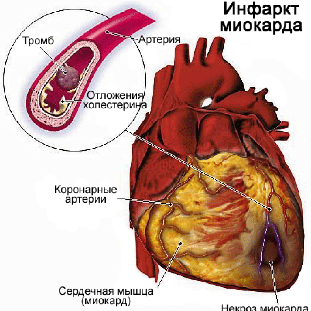 тромб в сердце фото