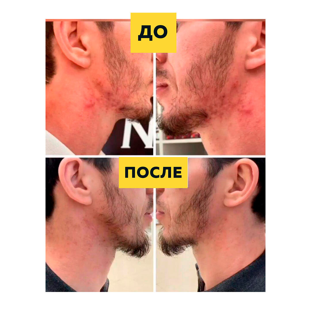 Спрей для кожи от прыщей Silver Shein Новинка 
Избавляет от многих проблем кожи тем самым улучшая не только вид кожи, но и эффективно воздействует на источник возникновения проблемы.



Сильвер Шейн это нечто новое, эффективное средство, который показал себя на практике. Направлен на устранение : •прыщей •угревой сыпи •акне, постакне •веснушек •черных точек •гусиной кожи •бородавок •купероза •пигментных пятен • подкожных клещей •веснушек •загара Нужно отметить что на Сильвер Шейн уже есть много довольных клиентов. Сильвер назначен не только для проблемной кожи лица, но и эффективно борется с прыщами на шее, плечах и на спине.



Подходит как мужчинам, женщинам и подросткам. Сильвер в отличии от других средств от проблемной кожи не сушит кожу, делает ее гладкой , заметно осветляет , сужает поры, постакне.