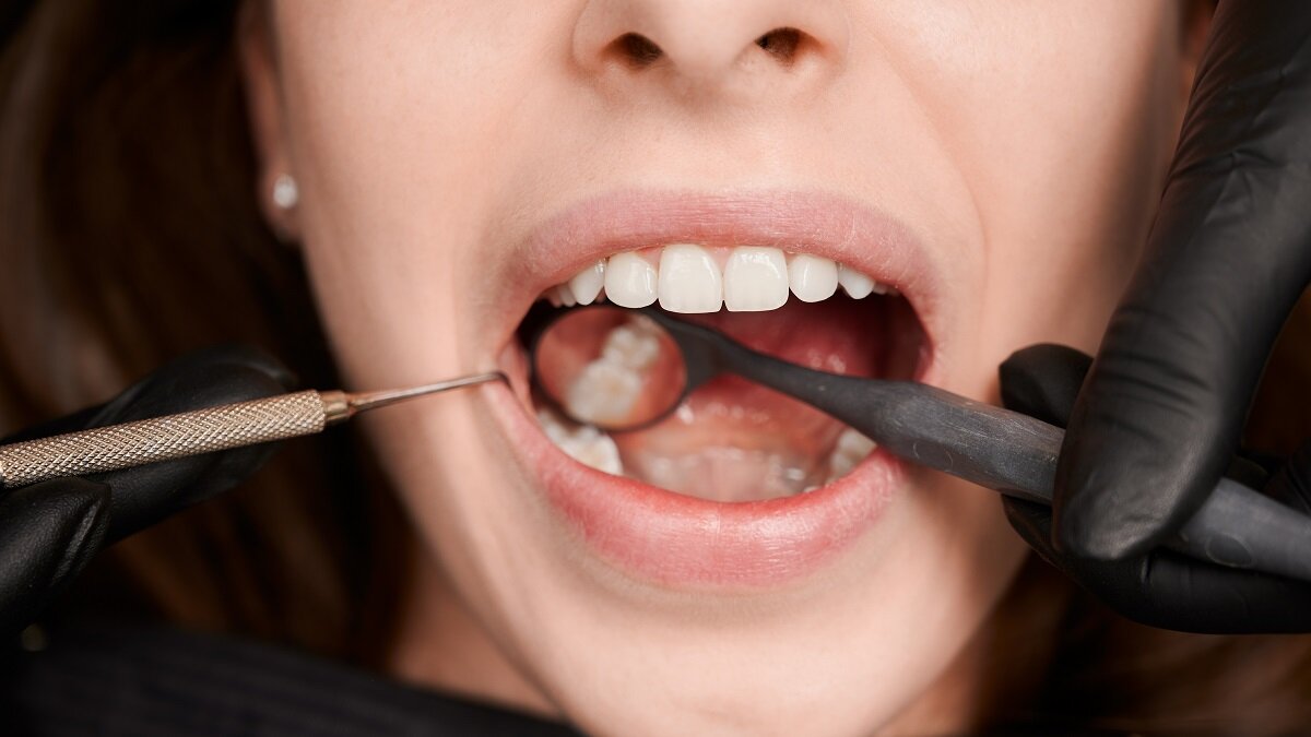    Замена пломбы