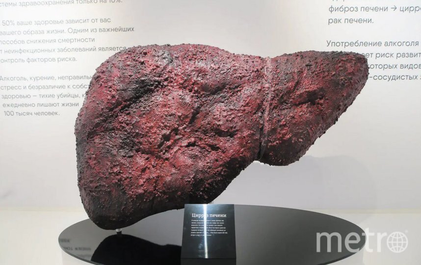    Ежегодно в мире 3 миллиона смертей являются результатом пагубного употребления алкоголя. Такая печень у его жертвы. Василий Кузьмичёнок / Metro.