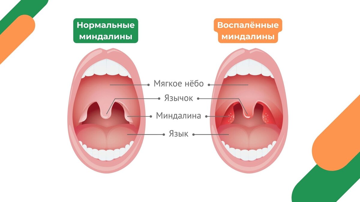 Психосоматика ангины у ребенка. Вирусная и бактериальная ангина. Горло здорового человека и больного.