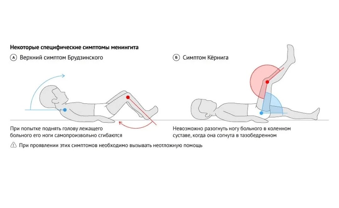 Симптом брудзинского при менингите. Ребенок перенес менингит. Менингит профилактика заболевания. Ребенок перенес менингит. Менингит симптомы у детей 10 лет.