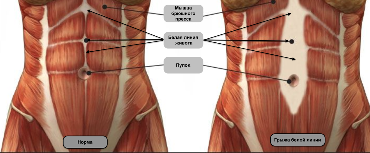 Прямая линия грыжа. Диастаз прямой мышцы живота. Диастаз мышц белой линии живота. Диастаз белая линия живота норма.