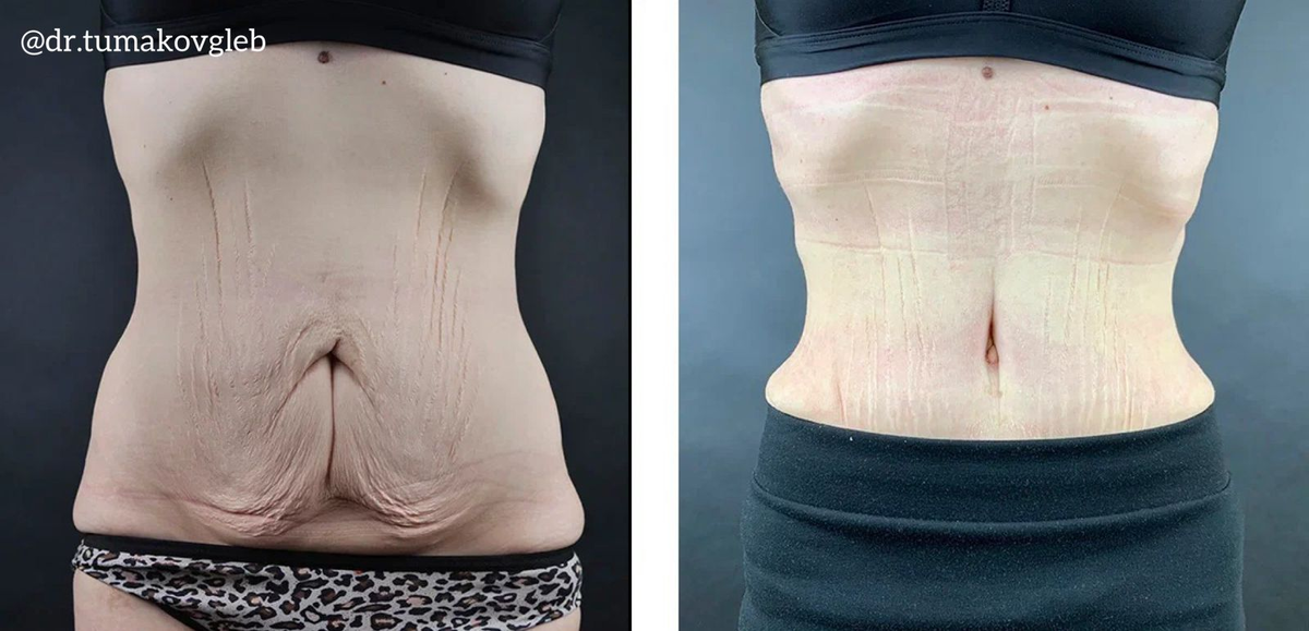 Результат абдоминопластики после массивного похудения.