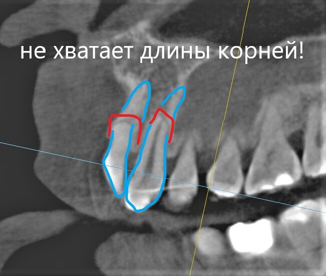 Лечение под микроскопом воспаления у корня зуба