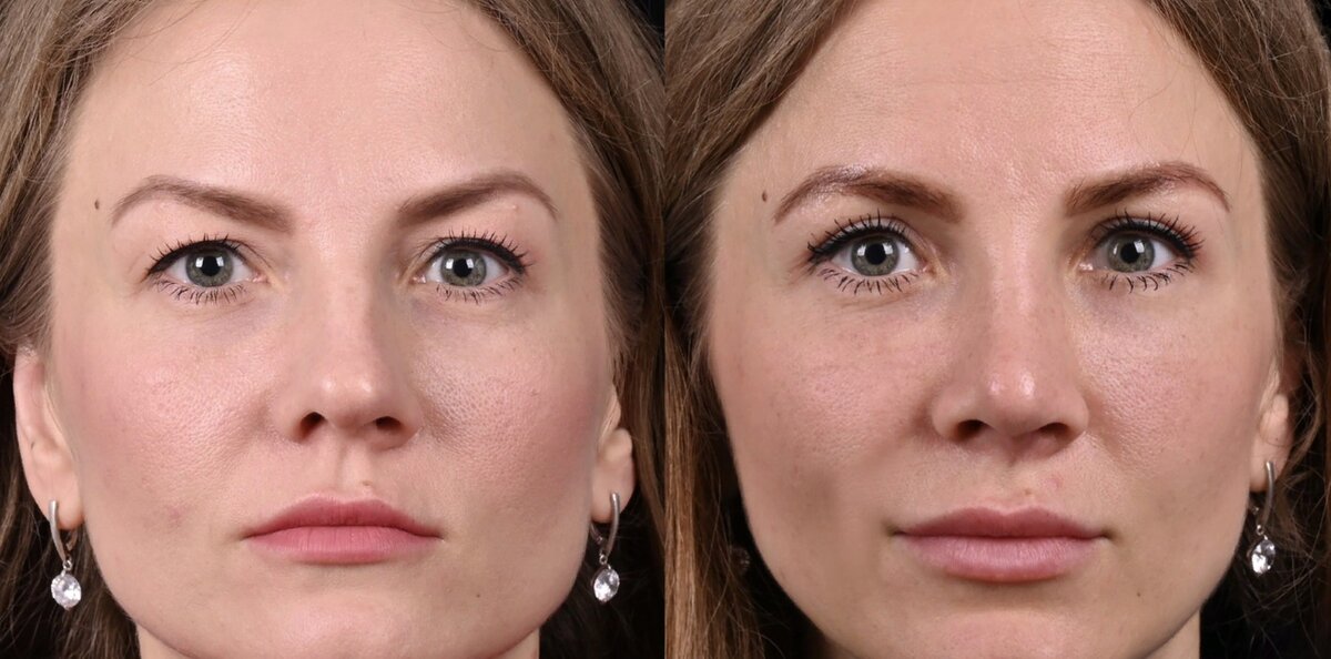 Устранили излишки кожи на верхнем веке и выполнили липофилинг носослезной борозды. Фото до и после. Фото с сайта хирурга Д.Р. Гришкяна. Имеются противопоказания, требуется консультация специалиста