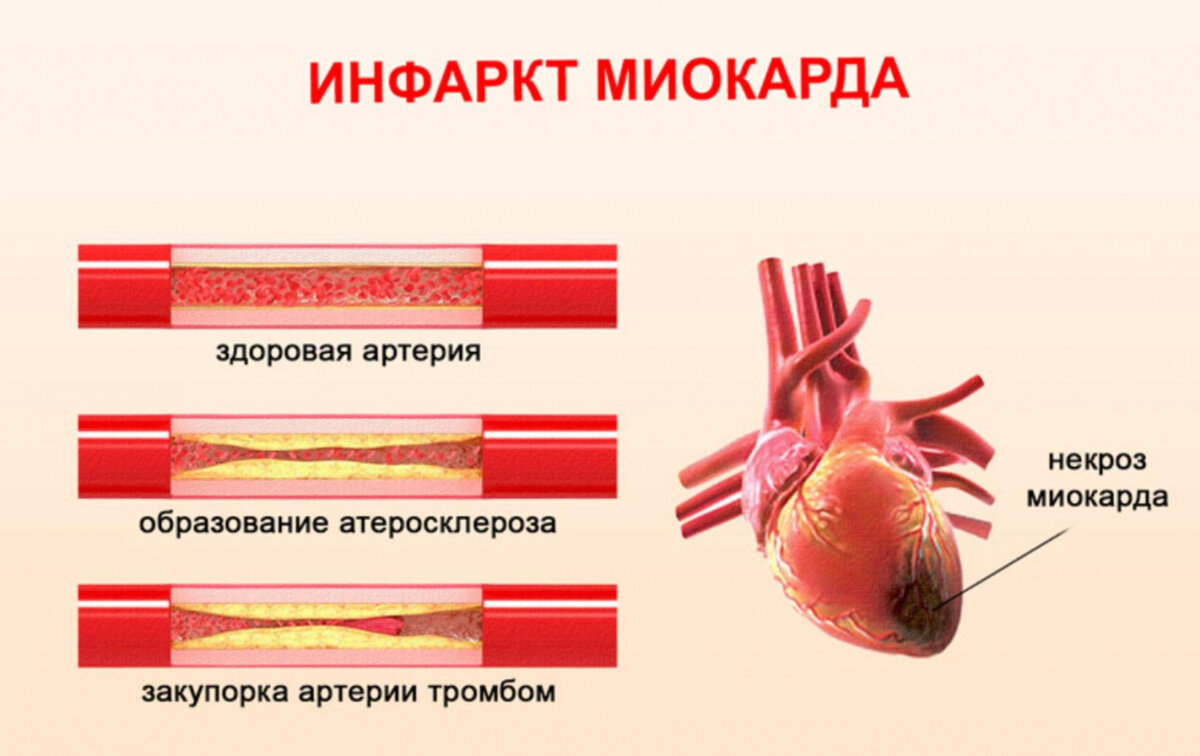 Картинки симптомы инфаркта миокарда