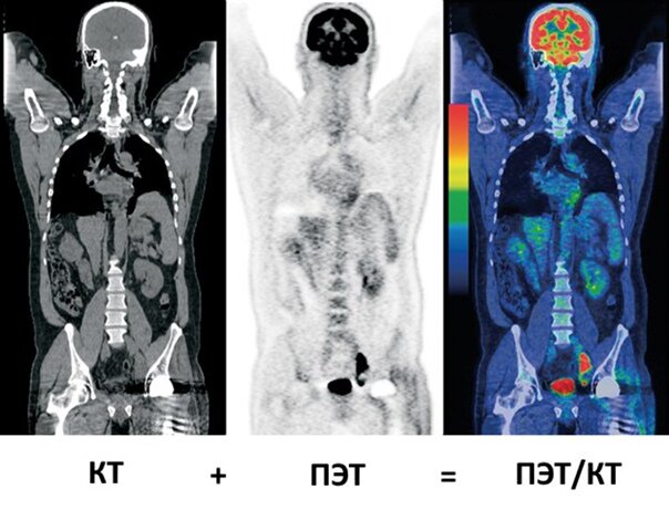 ПЭТ КТ в онкологии