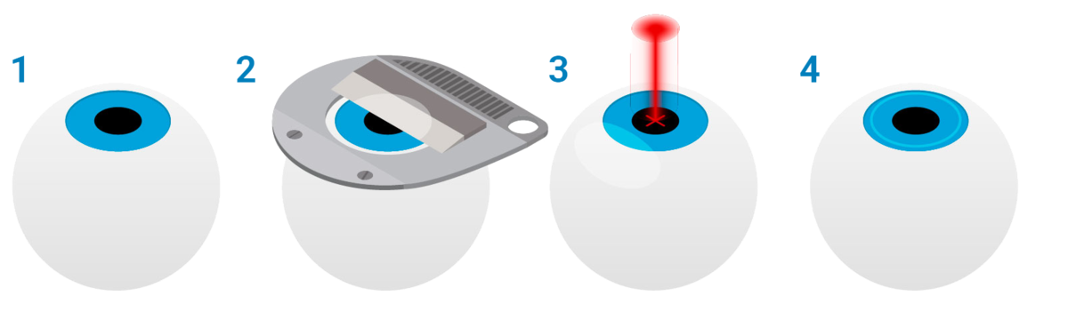 Этапы лазерной коррекции зрения методом Super LASIK
