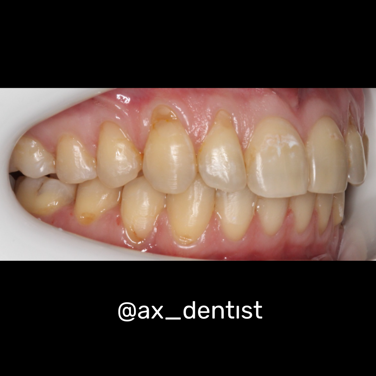 Пример клиновидного дефекта зубов