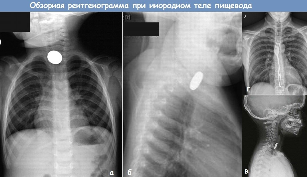 Инородные тела пищевода на рентгеновских снимках. Источник - Яндекс. Картинки.