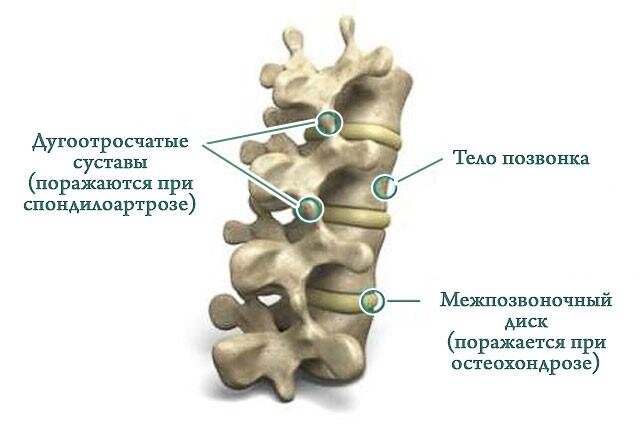 Что такое спондилоартроз позвоночника