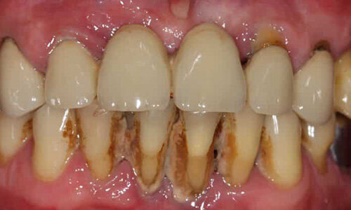 Больные зубы – источник хронических заболеваний