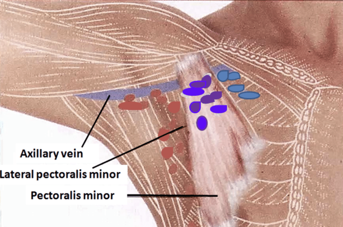 Подмышечные лимфоузлы (точки трех цветов), окруженные мышцами 