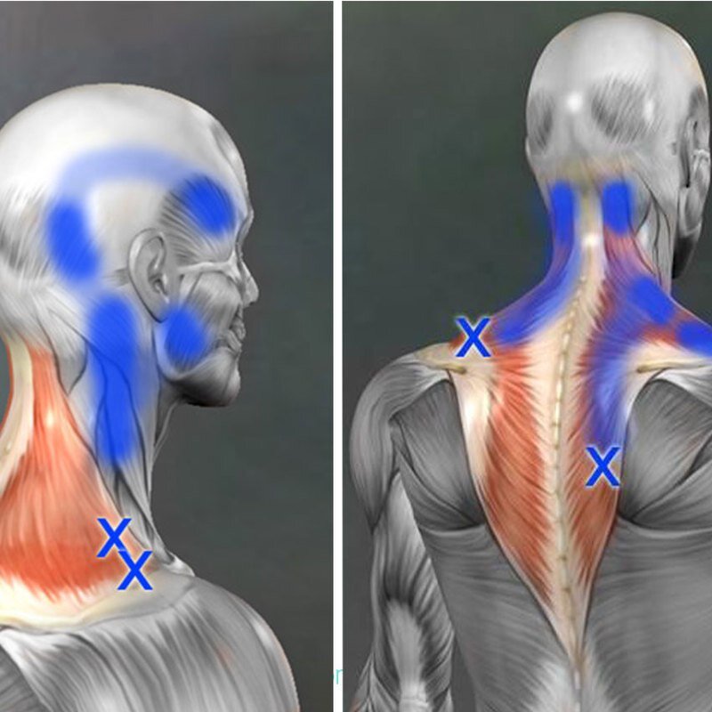 Триггерные точки трапециевидной мышцы