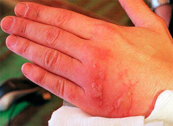 Вот так выглядит обморожение II степени