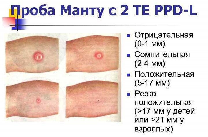 О реакции Манту