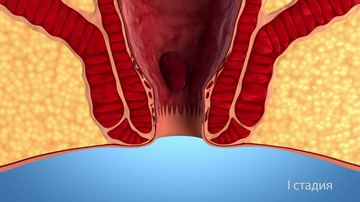 1 стадия внутреннего геморроя