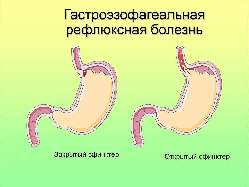 Почему возникает ощущение «кома в груди» - 7 наиболее частых причин