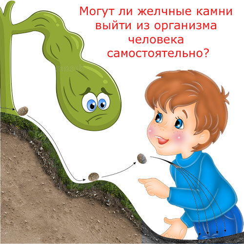 Могут ли желчные камни выйти из организма человека самостоятельно?