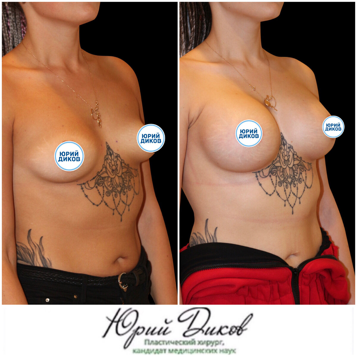 тубулярная деформация груди у женщин фото 62