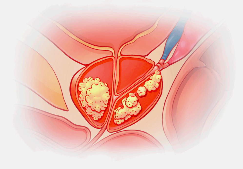 Рак простаты
