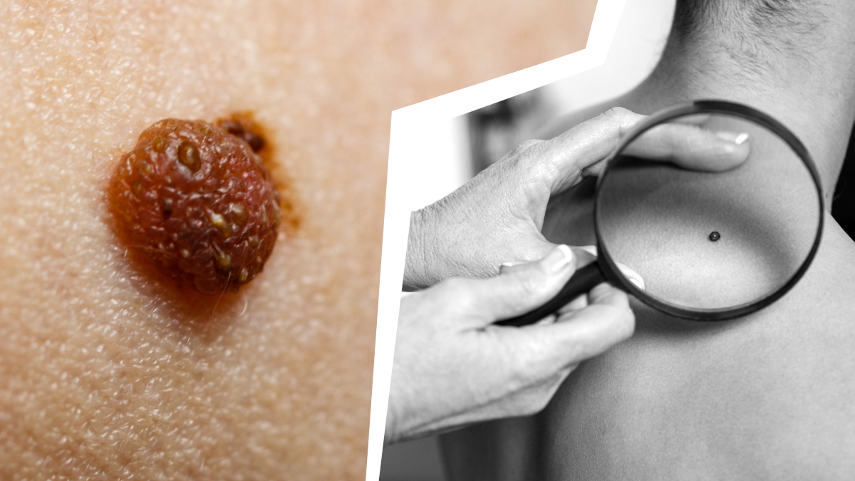 Как распознать опасную родинку