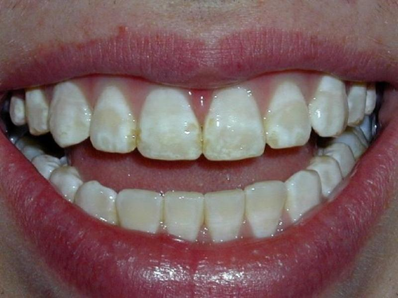 Зубов причины. Меловидно крапчатый флюороз. Меловидно крапчатая форма флюороза.