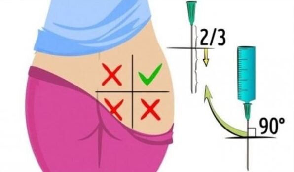 Как делать укол в ягодицу: очень подробная инструкция - Лайфхакер