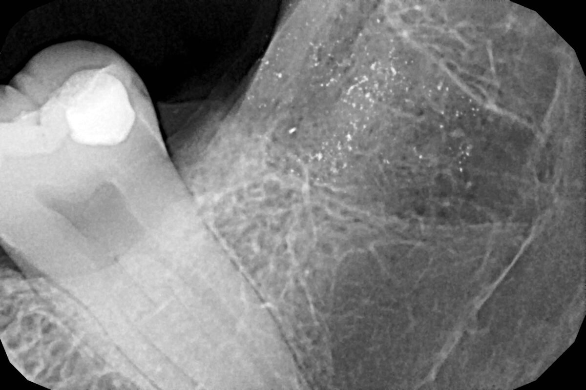 Выглядит воот так. В хирургии применяется для установки диагноза и после удалений в целях контроля качества манипуляции (не только для того, чтобы убедиться, что там ничего нет, а так же, чтобы увидеть межкорневую перегородку, костные пики и соседние зубы)



