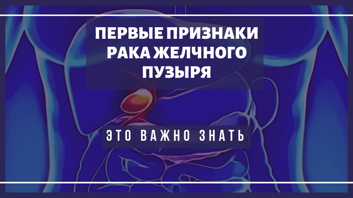 Разрыв желчного симптомы. Rак желчного пузыря. Опухоль желчного пузыря. Онкология желчного пузыря. Карцинома желчного пузыря.