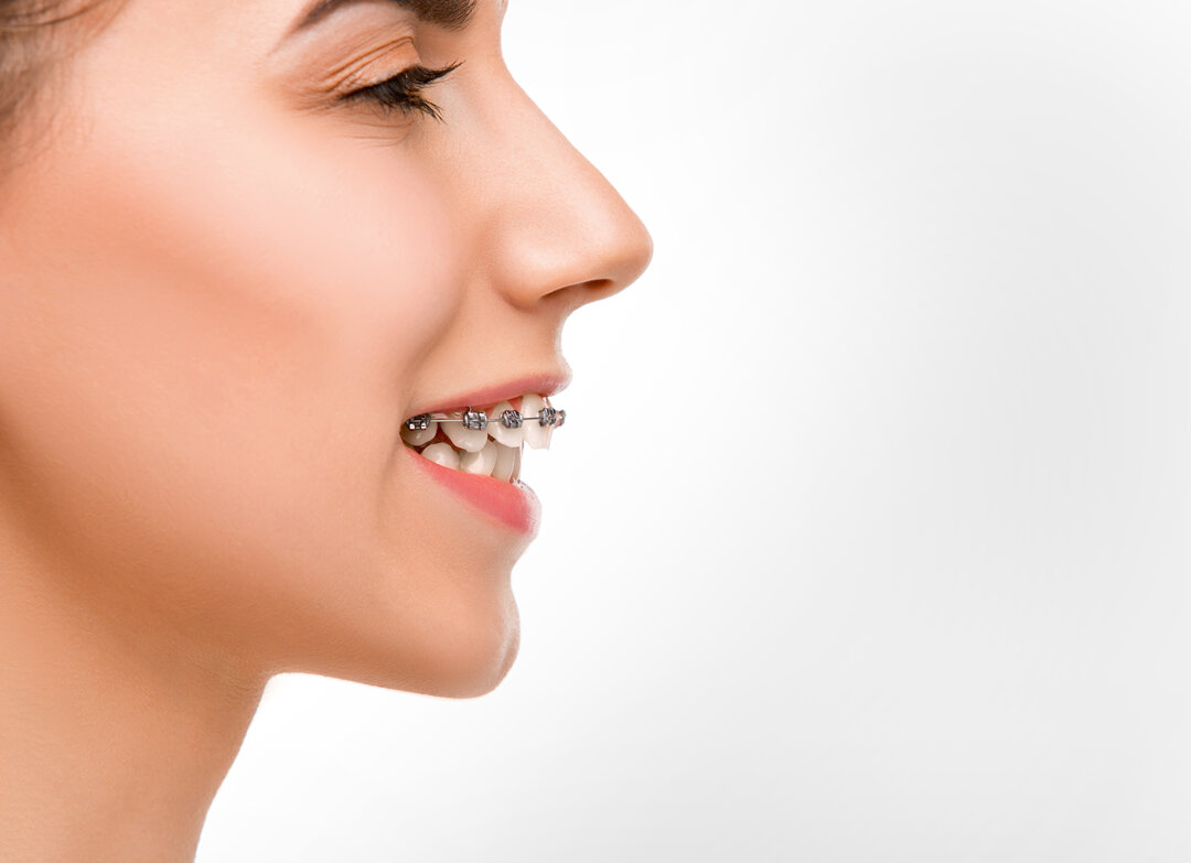 Самолигирующие брекеты pitts 21. Можно по полису поставить брекеты. Спец лезгинка на брекеты. «clarity sl» (3m unitek, сша),. Можно по полису поставить брекеты.