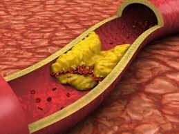 Бляшка, мешающая току крови
