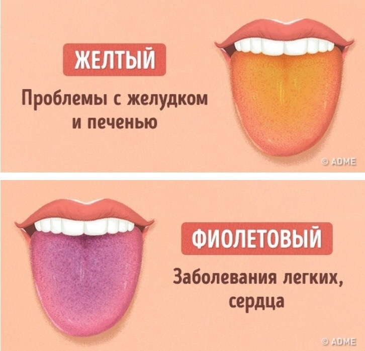 Болезни по цвету языка таблица Что значит цвет налета на вашем языке? осторожно, здесь очень полезно . Дзен