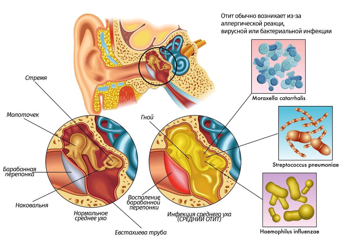 Что такое отит? Виды и лечение заболевания | Доктор ЕЛАМЕД | Дзен