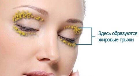 Что такое грыжи век?