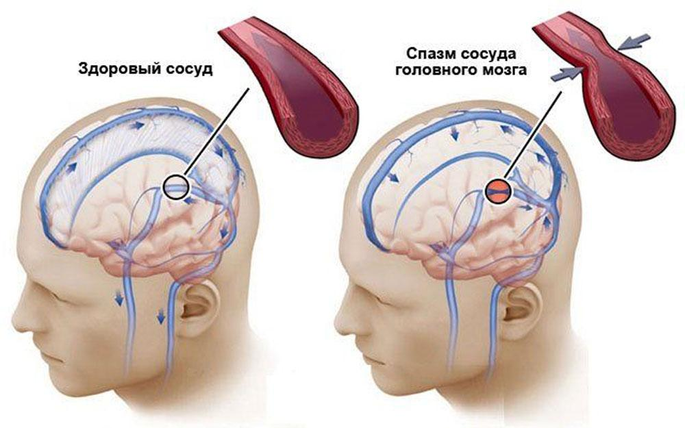 Спазм сосудов головного мозга. Сосудистый спазм головного мозга. Патология сосудов головного мозга.