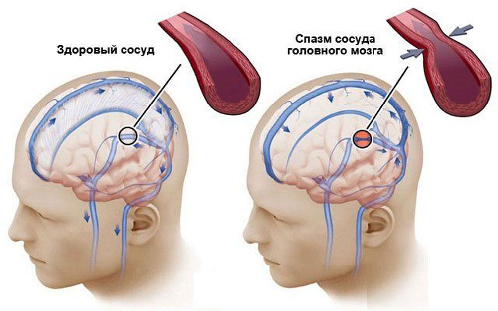 Как улучшить состояние сосудов головного мозга. Ангиодистония сосудов головного. Ангиодистония сосудов головного мозга что это такое. Сосудистый спазм головного мозга. Ангиоспазм сосудов головного мозга.