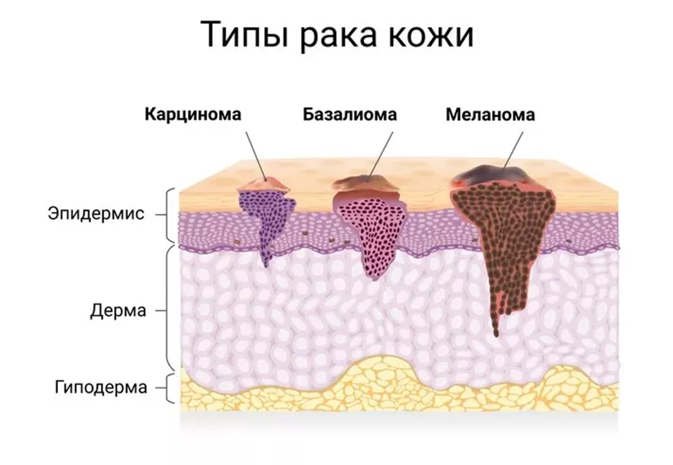 Базалиома кожи - лечение и удаление.