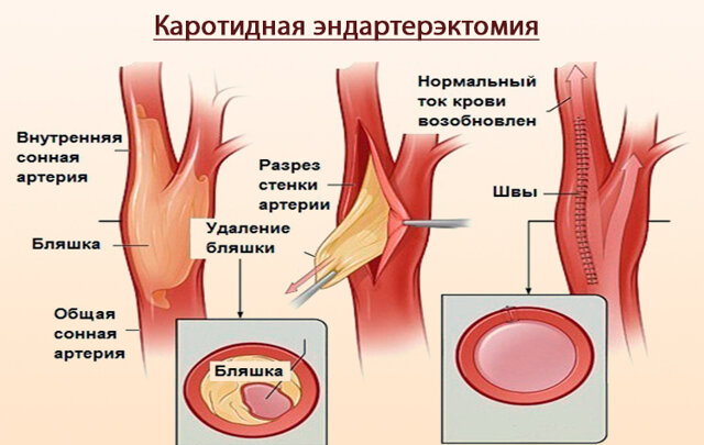 На этой картинке видно, что операция не так проста. Она требует высокой квалификации хирурга, и сопряжена с высоким риском.