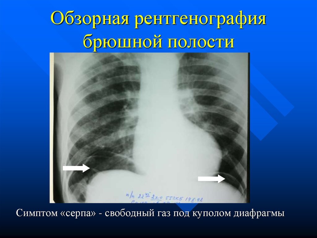 В норме между печенью и диафрагмой нет воздуха. Его наличие позволяет утверждать, что брюшная полость разгерметизирована. Так бывает при травмах или перфорации кишечника в результате разрыва язвенного дефекта.