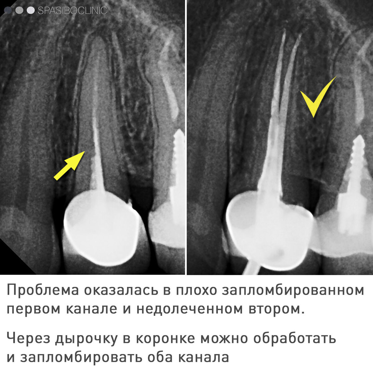 ЛЕЧЕНИЕ ПОД КОРОНКОЙ | Спасибо.Клиник | Дзен