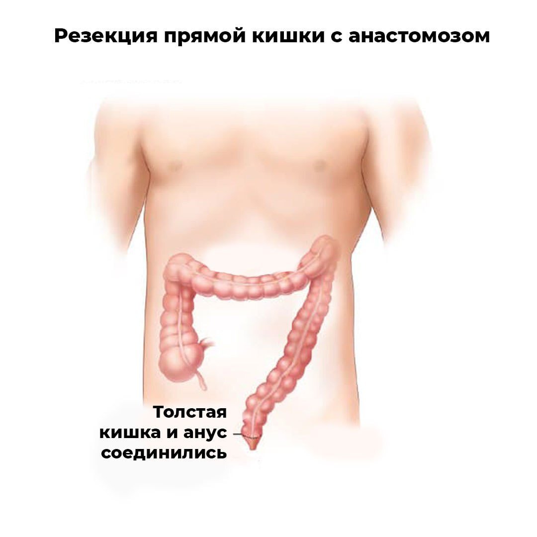 Рак анального канала Заболевания