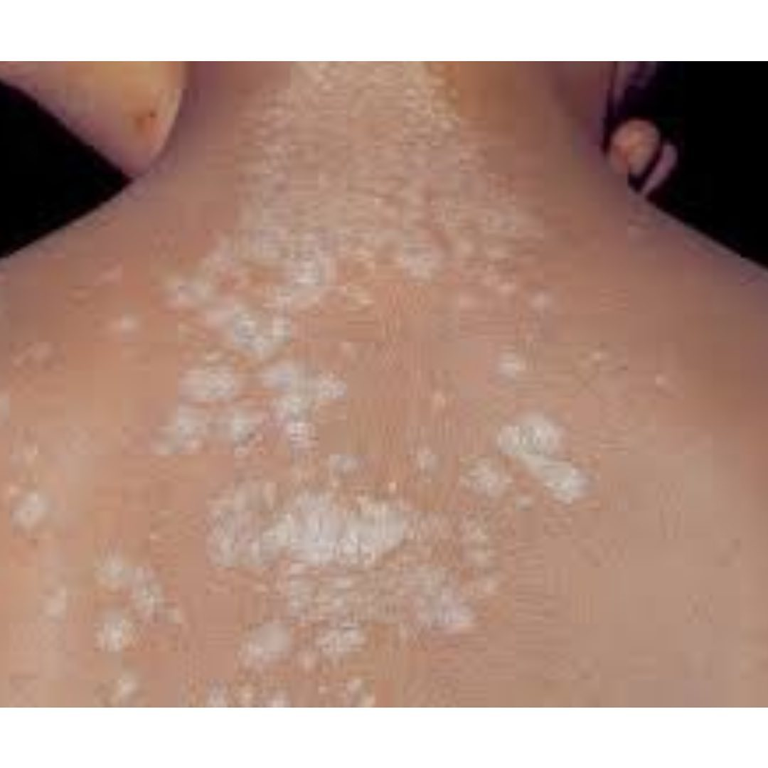 Проявления заболевания на спине 