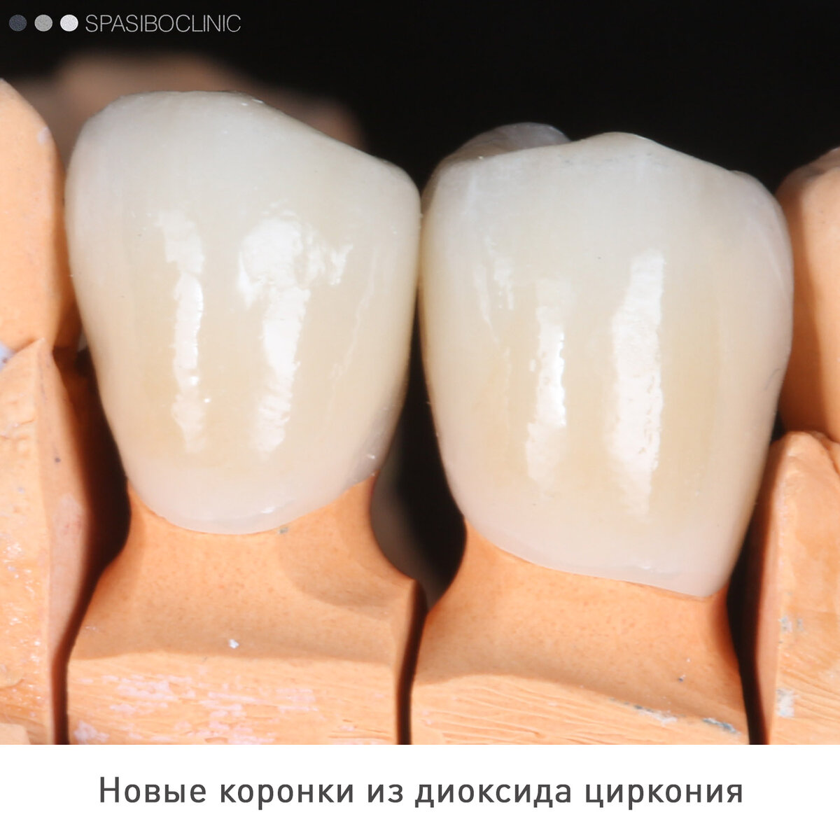 Как устанавливается штифт. На какие зубы можно ставить коронки. Культевая вкладка и коронка схема. На какие зубы можно ставить коронки. Цельнолитая культевая вкладка.