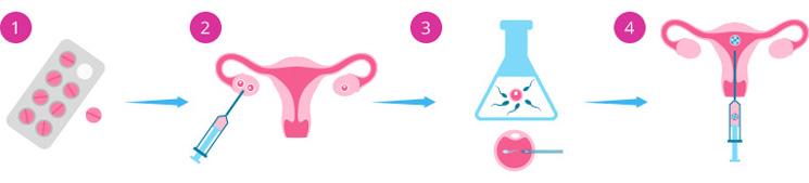 Методы искусственной инсеминации. Экстракорпоральное оплодотворение схема. Этапы экстракорпорального оплодотворения. Метод эко что это. Метод эко что это.