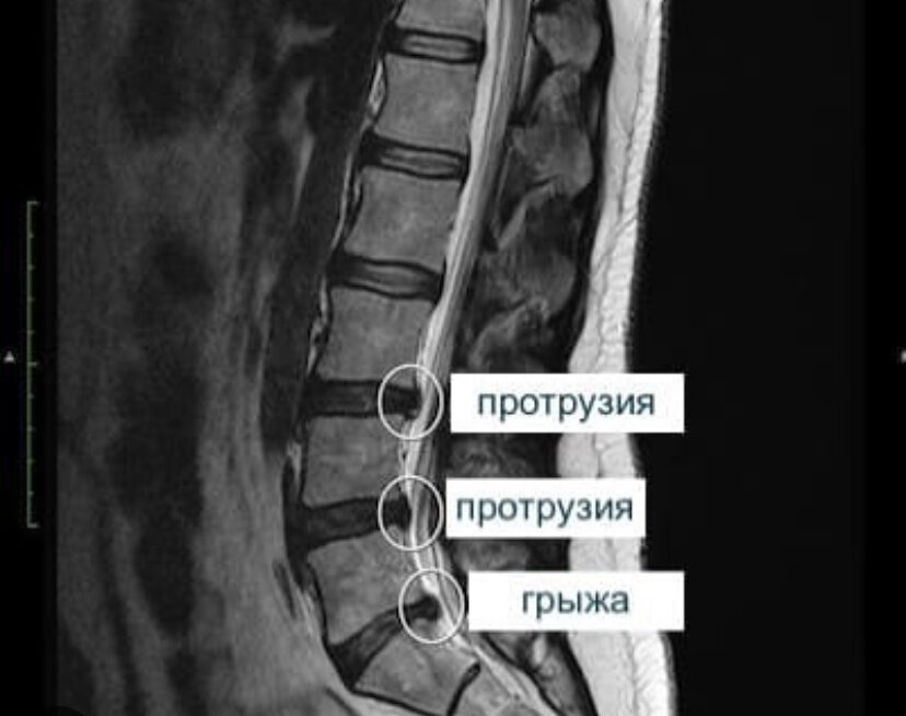 Грыжа диска спина. Протрузия дисков поясничного крестцового отдела. Мрт позвоночника пояснично-крестцового отдела (l1-s1). Мрт грыжи поясничного отдела позвоночника. Протрузия пояснично-крестцового отдела на мрт.