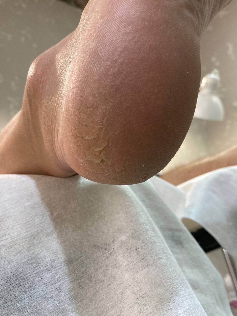 Как работать с трещинами?

Все чаще и чаще к нам приходят на процедуру педикюра клиенты с трещинами. Давайте подробнее разберемся, что это такое и почему они появляются? И как мастеру педикюра с ними работать?
Виды трещин:
1.Разрыв базальной мембраны – нарушается деление клеток, новые клетки могут создаваться деформированными. Между клетками нет связей получается пустота – трещина.
Такие трещины называются Эпидермодермальные – они находятся в 2-ух слоях кожи, глубокие в них можно увидеть розовый цвет-живые слои эпидермиса или кровь - а это значит, что трещина ушла в дерму.
•Отправляем ко врачу, часто к таким трещинам в 70% добавляется грибок, доктор должен выяснить причину образование трещин.
При работе с глубокими трещинами внутрь не лезем, не пилим. Промыли трещину (рану) перекисью, потом хлоргексидином.
•Санация трещины ( перекись водорода)
•Лейкопластырь
•Домашний уход
•Отправляем ко врачу
2. Разрыв межклеточных связей (десмосом)
Эпидермальные трещины, они поверхностные в эпидермисе.
Десмосо́мы — межклеточные контакты, обеспечивающие структурную целостность слоёв клеток за счёт связывания воедино их сетей. Их повреждение приводит к потере взаимодействия между соседними клетками.
Лечение:
•Отправляем ко врачу, доктор должен выяснить причину образование трещин.
•Постепенный опил ( 5 процедур)
•Домашний уход
•Правильное питание и устранение внутренних причин
•Контроль заживления трещин по фото
Причины появления трещин:
внутренние: нарушение обмена веществ, сахарный диабет, авитоминоз, плоскостопие, и др.
внешние: неудобная обувь, ношение синтетических носков, несоблюдение правил личной гигиены.
Для профилактики появления трещин на стопах необходимо:
✅уделять внимание качеству и частоте педикюра;
✅соблюдать гигиену кожи стоп – мыть ноги не менее двух раз в день;
✅при необходимости применять препараты, которые увлажняют кожу стоп и смягчают ее, уменьшают потоотделение, препятствуют шелушению и возникновению грибковых заболеваний;
✅при плоскостопии пользоваться специальными стельками и супинаторами, а также носить ортопедическую обувь;
✅отказаться от синтетических носков, колгот, тесной обуви, туфель и босоножек на высоких каблуках, без фиксирующих ремешков;
Трещины - это следствие сухой и утолщенной кожи, по-другому кератоза. А кератоз развивается когда ороговевшие клетки кожи не успевают отшелушиваться и наслаиваются друг на друга. Для избежания кератоза надо обязательно посещать мастера по педикюру 1 раз в 3 недели, чтобы своевременно убирать сухую кожу.
А мастер педикюра должен грамотно проводить уходовую процедуру стопы и пальчиков. Для этого он должен знать главные требования к созданию безопасного педикюра. Что можно делать в педикюре, а что нельзя 🚫
Убирать трещины надо в динамике, не за одну процедуру. Мастеру нельзя перепилить кожу иначе эффект будет обратный.
Нельзя чистить стопы до розовой кожи (живых клеток эпидермиса), так как в ответ на интенсивное раздражение кожа будет активнее наращивать роговой слой, стремясь защитить живые клетки: это может стать причиной гиперкератоза и глубоких трещин.
По этой же причине нельзя чистить стопы слишком часто. Ориентируйтесь на жизненный цикл клеток кожи: он составляет 3-4 недели. За это время клетки базального слоя, преобразуясь, достигают верхнего рогового слоя, где в итоге слущиваются и уступают место более новым. Это естественный и слаженный процесс, поэтому не нужно излишне усердствовать, помогая коже обновляться – в противном случае она активизирует защитные функции, и вы получите обратный эффект.